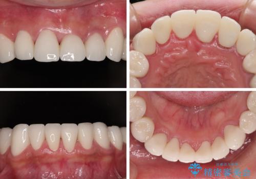 受け口傾向の咬み合わせを治したい 全顎セラミック治療の治療後