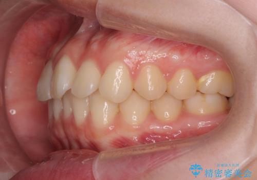 前歯のねじれをマウスピース矯正で治したいの治療後