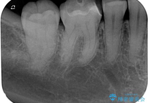 金属の詰め物が目立つのでやり替えたい ハイブリッドインレー修復の治療後