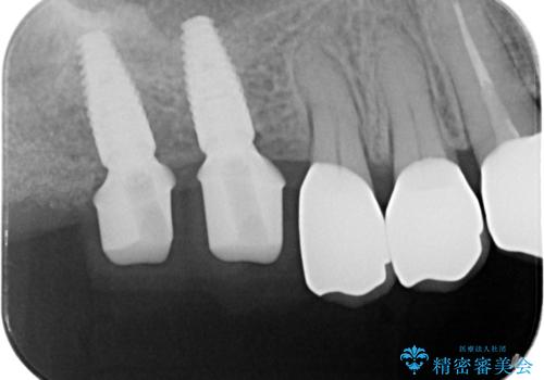 ブリッジのぐらつき　インプラントを用いた奥歯の噛み合わせの再構築の治療中