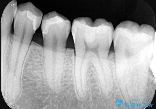 左下小臼歯|接触面カリエスに対するセラミックインレー修復の治療後