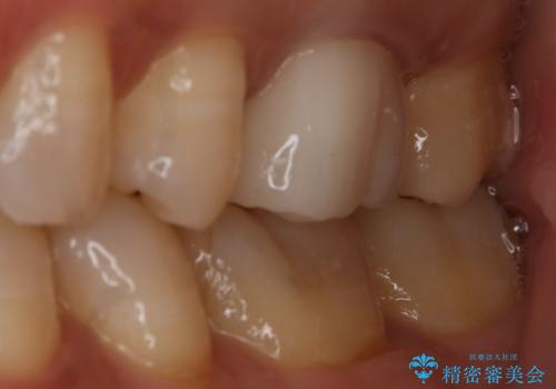 銀歯を白くしたい セラミックインレーの治療後