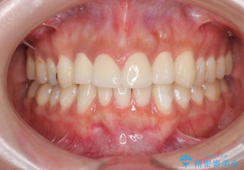 充填物の変色を繰り返す前歯のセラミック治療の治療後