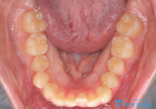 前歯のねじれをマウスピース矯正で治したいの治療前