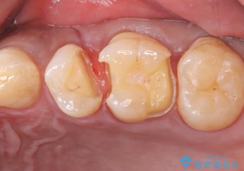 【セラミックインレー】ホワイトニングしに来たら虫歯が見つかったの治療中
