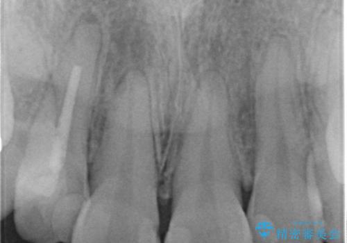 充填物の変色を繰り返す前歯のセラミック治療の治療前