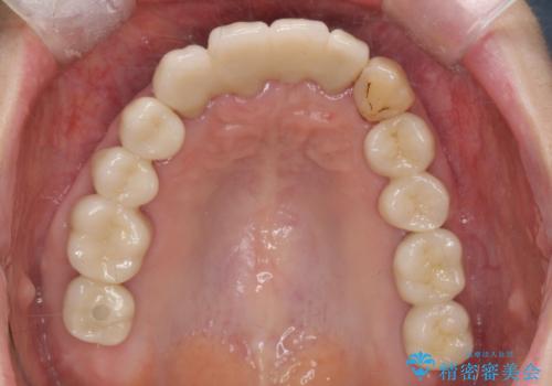歯周病 、インプラント、 矯正 全顎治療の治療後