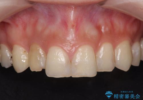充填物の変色を繰り返す前歯のセラミック治療の症例 治療前