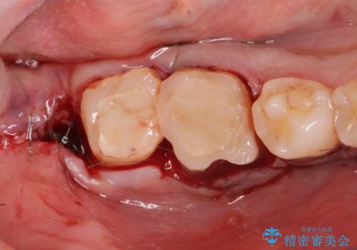 スペース狭小な銀歯を白くしたい 歯冠長延長術を併用したセラミック治療の治療中
