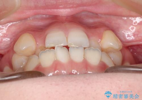 MARPEで非抜歯矯正|オープンバイトと八重歯を改善の治療前