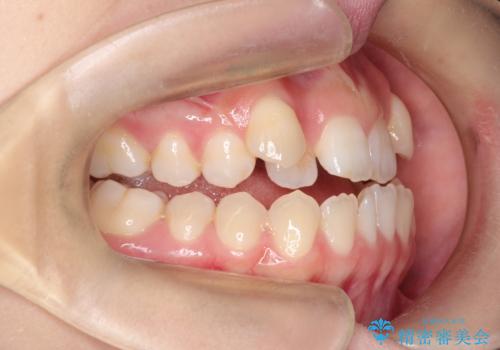 MARPEで非抜歯矯正|オープンバイトと八重歯を改善の治療前