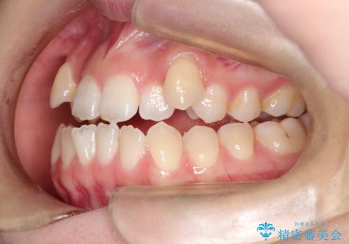MARPEで非抜歯矯正|オープンバイトと八重歯を改善の治療前