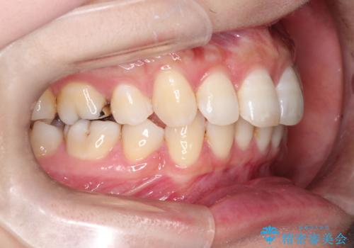 再び気になり始めた前歯のがたつき|インビザラインによる再矯正の治療前