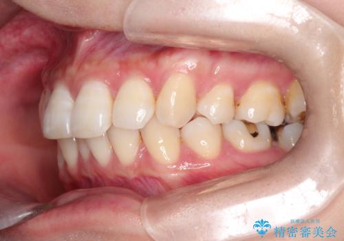 再び気になり始めた前歯のがたつき|インビザラインによる再矯正の治療前