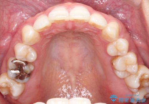 再び気になり始めた前歯のがたつき|インビザラインによる再矯正の治療前