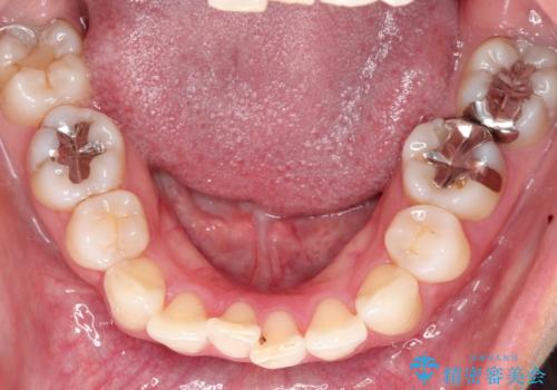 再び気になり始めた前歯のがたつき|インビザラインによる再矯正の治療前