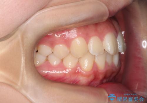 下顎前歯の叢生をインビザラインで改善|目立たず整った歯並びへの治療前