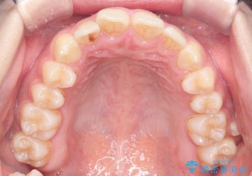 下顎前歯の叢生をインビザラインで改善|目立たず整った歯並びへの治療前