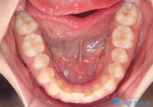 下顎前歯の叢生をインビザラインで改善|目立たず整った歯並びへの治療前