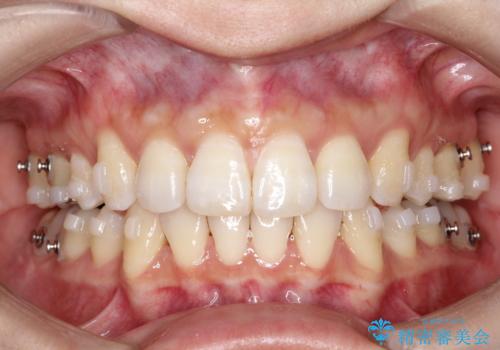 再び気になり始めた前歯のがたつき|インビザラインによる再矯正の治療中