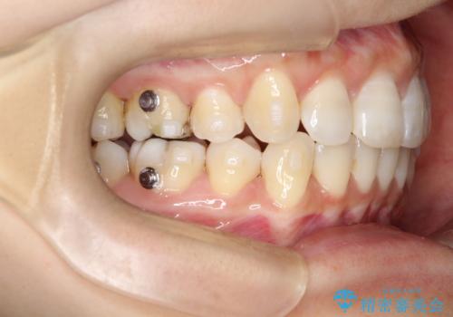 再び気になり始めた前歯のがたつき|インビザラインによる再矯正の治療中