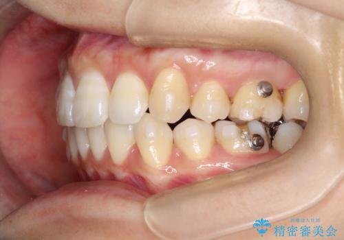 再び気になり始めた前歯のがたつき|インビザラインによる再矯正の治療中