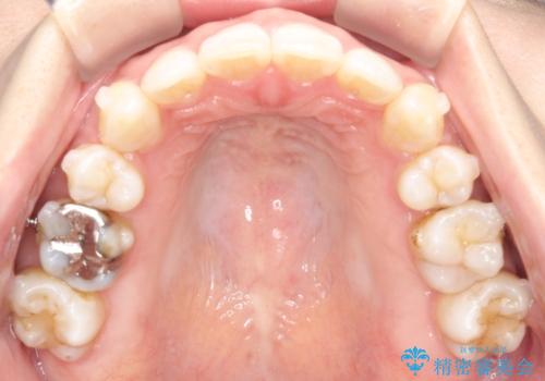 再び気になり始めた前歯のがたつき|インビザラインによる再矯正の治療中