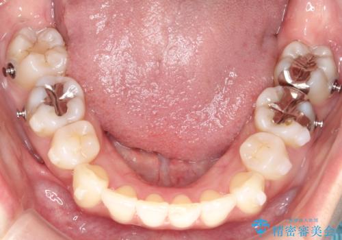 再び気になり始めた前歯のがたつき|インビザラインによる再矯正の治療中