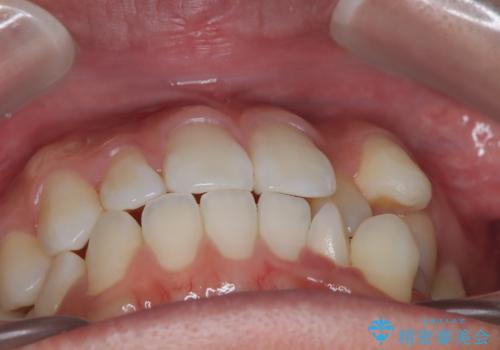 白い装置で八重歯を改善|抜歯矯正で見た目と噛み合わせ向上の治療前