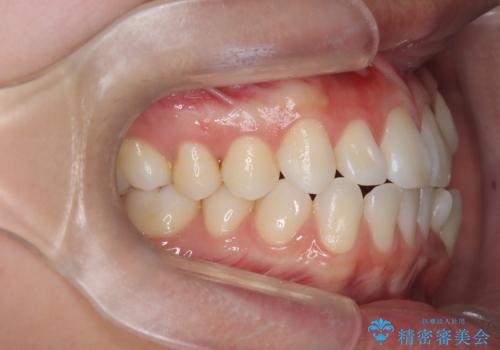 白い装置で八重歯を改善|抜歯矯正で見た目と噛み合わせ向上の治療前