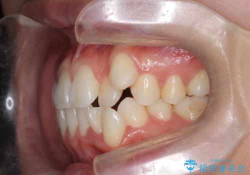 白い装置で八重歯を改善|抜歯矯正で見た目と噛み合わせ向上の治療前