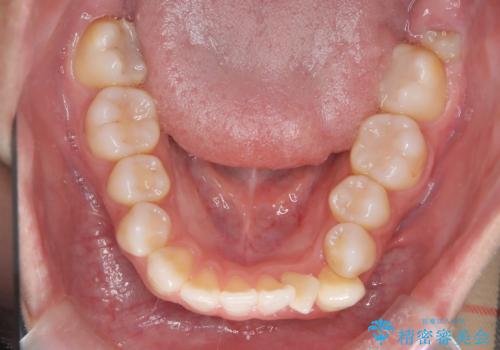 白い装置で八重歯を改善|抜歯矯正で見た目と噛み合わせ向上の治療前