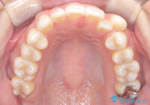 白い装置で八重歯を改善|抜歯矯正で見た目と噛み合わせ向上の治療前