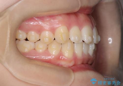 下顎前歯の叢生をインビザラインで改善|目立たず整った歯並びへの治療中
