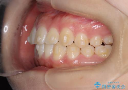 下顎前歯の叢生をインビザラインで改善|目立たず整った歯並びへの治療中