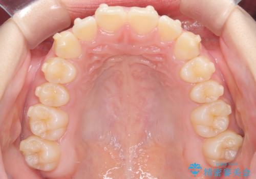 下顎前歯の叢生をインビザラインで改善|目立たず整った歯並びへの治療中