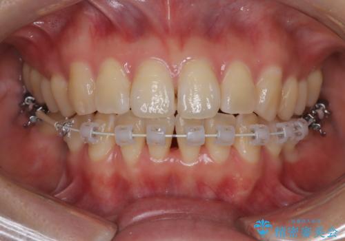 右下5番の先天欠如と前歯の叢生に対するワイヤー矯正とインプラント治療の治療中