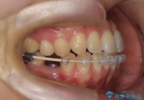 右下5番の先天欠如と前歯の叢生に対するワイヤー矯正とインプラント治療の治療中