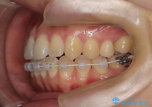 右下5番の先天欠如と前歯の叢生に対するワイヤー矯正とインプラント治療の治療中