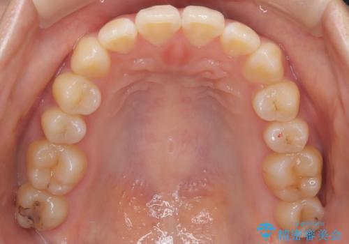 右下5番の先天欠如と前歯の叢生に対するワイヤー矯正とインプラント治療の治療中