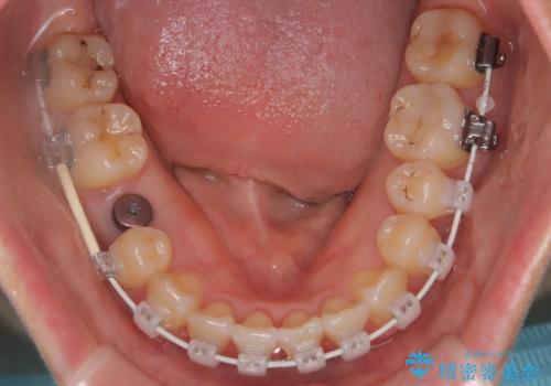 右下5番の先天欠如と前歯の叢生に対するワイヤー矯正とインプラント治療の治療中