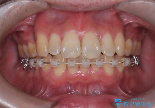 ハーフリンガル矯正による前歯部の叢生改善と口元の後退|上顎左右4番・下顎1番抜歯症例の治療中