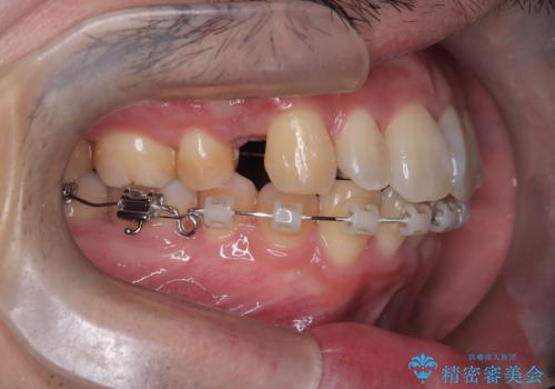 ハーフリンガル矯正による前歯部の叢生改善と口元の後退|上顎左右4番・下顎1番抜歯症例の治療中