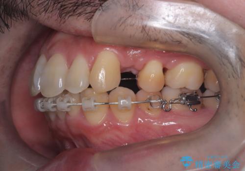 ハーフリンガル矯正による前歯部の叢生改善と口元の後退|上顎左右4番・下顎1番抜歯症例の治療中