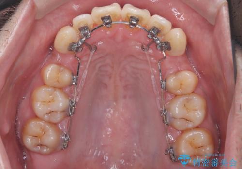 ハーフリンガル矯正による前歯部の叢生改善と口元の後退|上顎左右4番・下顎1番抜歯症例の治療中