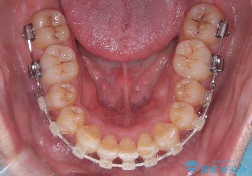 ハーフリンガル矯正による前歯部の叢生改善と口元の後退|上顎左右4番・下顎1番抜歯症例の治療中
