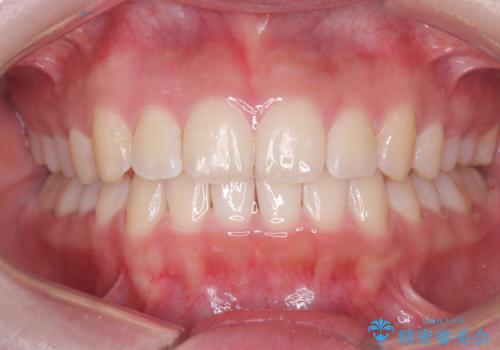 下顎前歯の叢生をインビザラインで改善|目立たず整った歯並びへの治療後