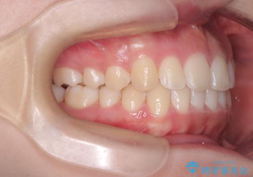 下顎前歯の叢生をインビザラインで改善|目立たず整った歯並びへの治療後