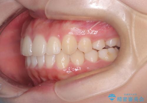 下顎前歯の叢生をインビザラインで改善|目立たず整った歯並びへの治療後