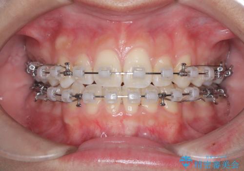 白い装置で八重歯を改善|抜歯矯正で見た目と噛み合わせ向上の治療中